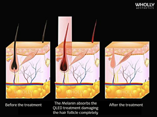 QLED HAIR REMOVAL - Wholly Aesthetics | Your Solution To Beauty Needs